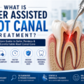 What Is Laser Assisted Root Canal Treatment? | Painless Modern Root Canal Guide