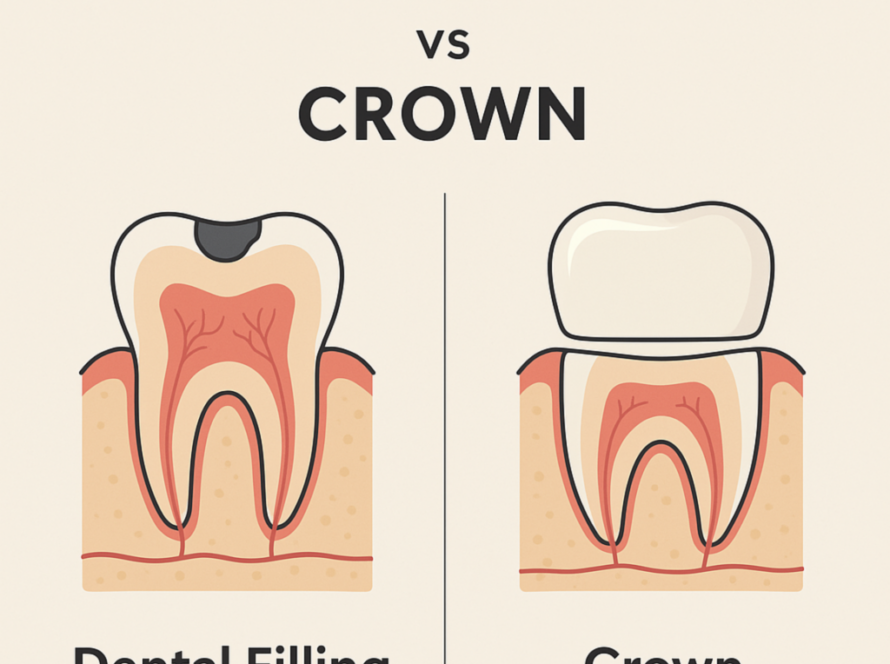 dental crown vas filling