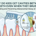 Why Do Kids Get Cavities Between Teeth Even When They Brush? 